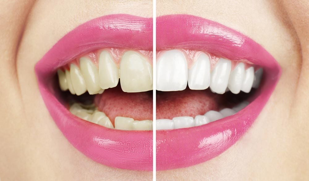 What Are the Benefits of Professional Teeth Whitening?