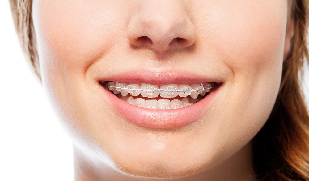 Why Do Ceramic Braces Take Longer?