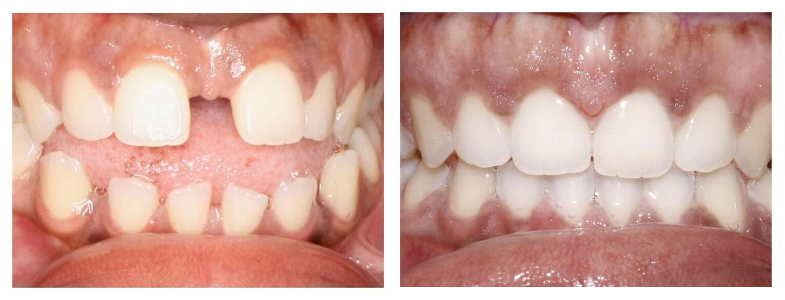 Invisalign before and after, gap and spacing issues, adult female