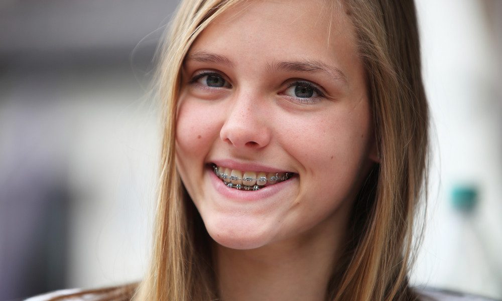 12 Things You Should Know Before Getting Braces