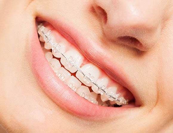 Clear Ceramic Braces in North Carolina - MyOrthodontist