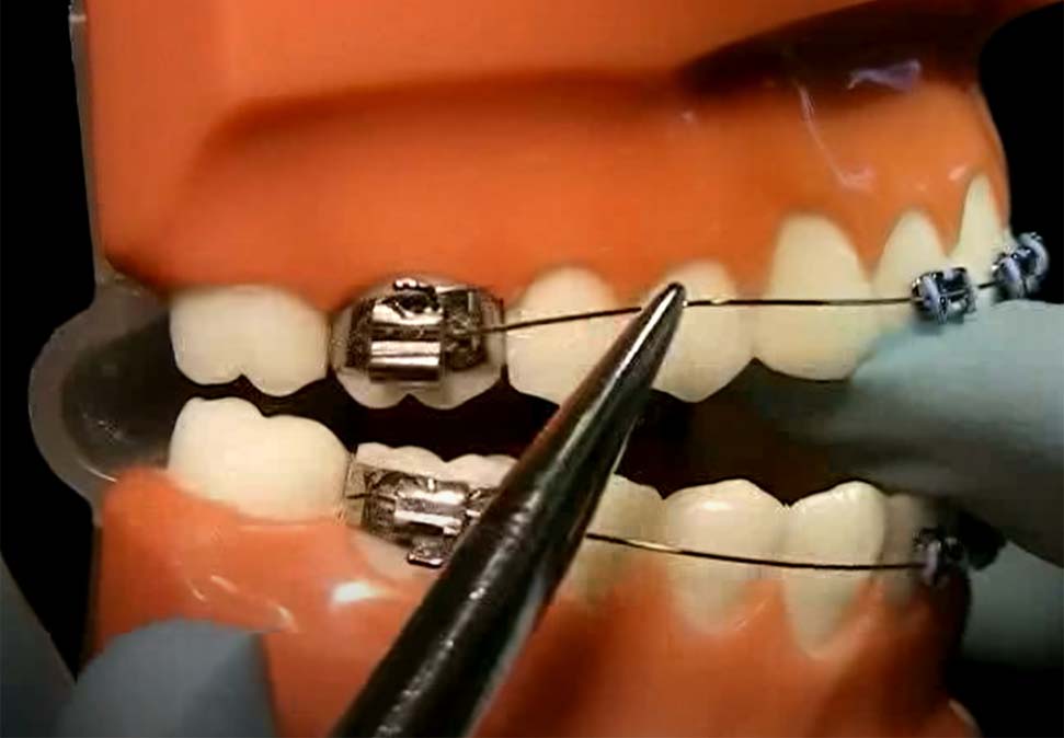 How to Fix a Loose or Broken Bracket - MyOrthodontist