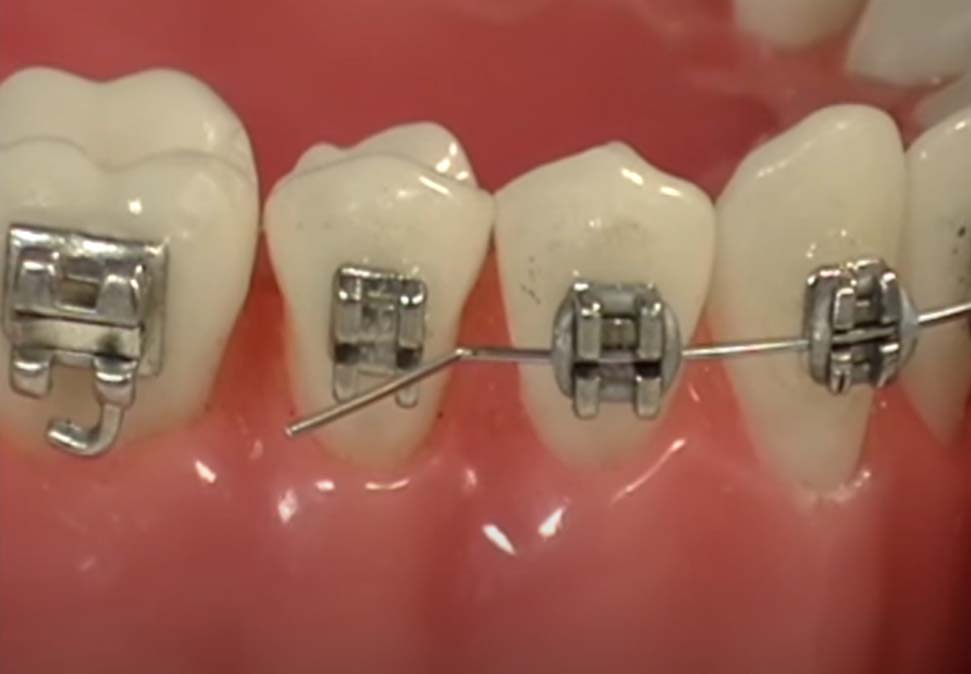 How to Fix a Poking Braces Wire - MyOrthodontist