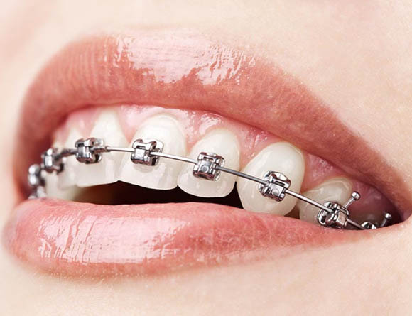 Metal Braces in North Carolina - MyOrthodontist