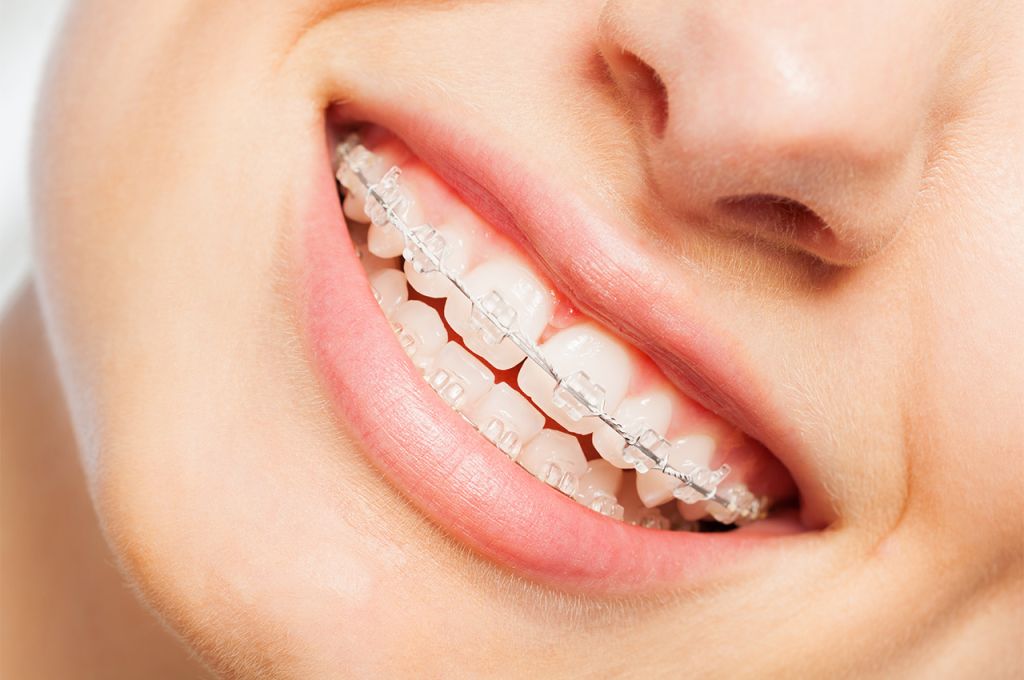 Six Hidden Benefits of Braces Improving More than just Aesthetics