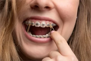 Elastics-for-Braces-Everything-You-Need-to-Know