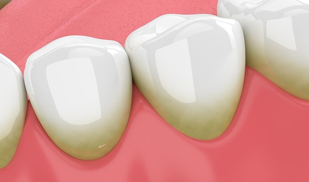 What Can a Dentist Do To Treat Gingivitis?